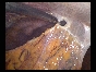 ADHESIONS BOWELS OMENTAL11 ADHESIONS BOWELS OMENTAL11